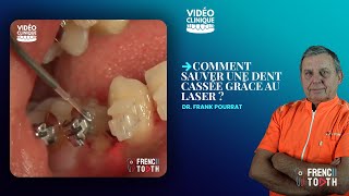 Comment sauver une dent cassée grâce au Laser   Dr Pourrat [upl. by Eelrebmik]