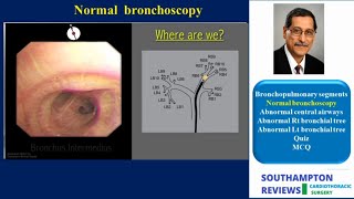 Bronchoscopy 2 [upl. by Retrac]