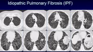 CHEST 2016 video sessions HRCT of the chest [upl. by Patton]