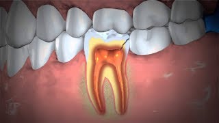 How To Treat Abscessed Tooth – Natural Cures For Abscessed Tooth [upl. by Ordway559]