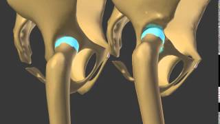 subluxation hip dysplasia developmental neo acetabulum build [upl. by Allister218]