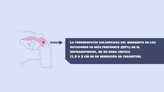 Caso clínico Tratamiento de calcificaciones en el tendón supraespinoso guiado con ecografía [upl. by Karl48]