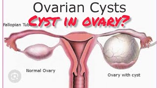 ovarian cyst with uterus cervix😱 grossing video  biopsy specimen cancer uterusproblem cyst tb [upl. by Ellenaej]