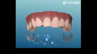 Invisalign simulazione [upl. by Assilanna]