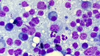 Reactive Lymphadenitis cytology [upl. by Aivirt]