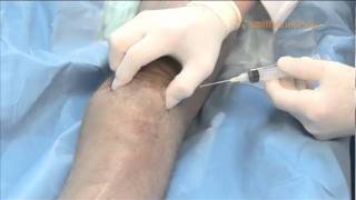 Superior Lateral Injection Technique [upl. by Hcir]