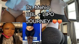 BBL JOURNEY 🍑 DR MEHIO 👨🏻‍⚕️ MIA AESTHETICS MIAMI ✈️ PREOP  POSTOP  BODY REVEAL [upl. by Aaren]