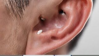 Top five dark blackheads in ear  blackheadsblackheads [upl. by Aicatsal41]