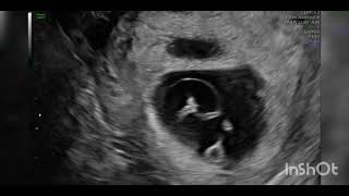 Twin reversed arterial perfusion TRAP sequence  acardia fetal ultrasound [upl. by Paugh]