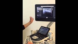 Echografie van de inguinale hernia  advanced course MSU [upl. by Ovatsug]