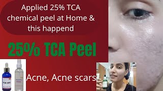 25 TCA chemical Peel At Home  in Hindi मैंने पहली बार अपने चेहरे पर 25 TCA Peel लगाया हैं [upl. by Coe208]