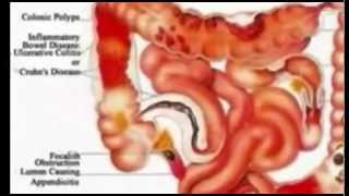 The Shocking Truth About Colon Hydrotherapy [upl. by Merp]