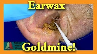 Earwax GOLDMINE  Auburn Medical Group [upl. by Aihsercal]