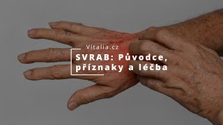 SVRAB SCABIES Původce příznaky a léčba [upl. by Sola]