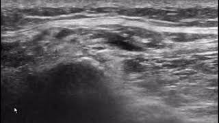 Ultrasonographic Technique for Imaging and Injecting the Superior Cluneal Nerve [upl. by Jay]