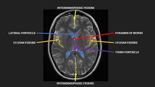 Introduction to MRI of the brain [upl. by Livesay866]