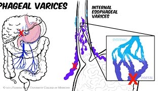 Portal Hypertension Animated Review [upl. by Mcgrath]