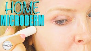 How to do Microdermabrasion at Home DIY [upl. by Hallvard]