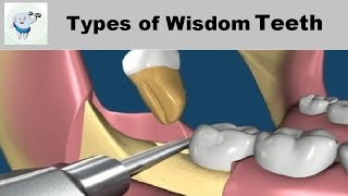 Types of Wisdom Teeth Removal [upl. by Suirauqram618]