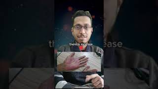 1 minute Clinical Short  Palmar Erythema  NEET SS Medicine Mrmedicine99 [upl. by Allemrac]