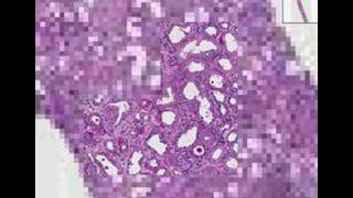 Histopathology KidneyRapidly progressive glomerulonephriti [upl. by Elleuqram]