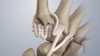 Osteoarthritis of the Thumb Surgical Treatment LRTI [upl. by Neelloc992]