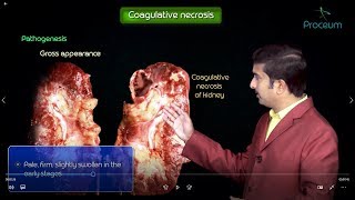 Necrosis and types of Necrosis  General pathology  Animated usmle videos [upl. by Hnacogn]