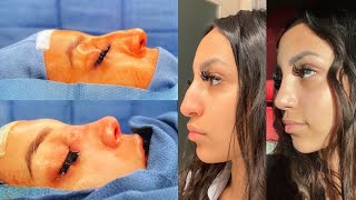 MY CLOSED RHINOPLASTY EXPERIENCE RECOVERY  RESULTS nose job vlog [upl. by Oirifrop]