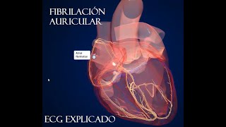 Fibrilación Auricular ECG Patogenia y tratamiento [upl. by Marcin188]