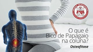 O que é BICO de PAPAGAIO na Coluna ou OSTEOFITOSE  Dr Diogo Neurocirurgião [upl. by Uriah96]