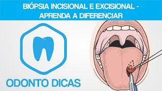 BIÓPSIA INCISIONAL E EXCISIONAL  APRENDA A DIFERENCIAR  ODONTO DICAS [upl. by Shawnee]