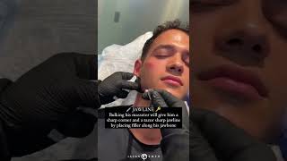 shorts MALE FACIAL SCULPTING  BELLASCULPT  Dr Jason Emer [upl. by Adiene397]