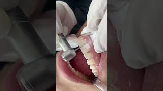 Fechamento de diastema com resina composta [upl. by Enyedy]