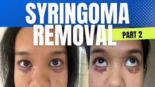 Syringoma Removal Part 2 Price Clinic Update etc [upl. by Danziger453]