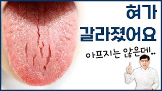 혀갈라짐 원인 제대로 알고 치료하세요 [upl. by Tilney]