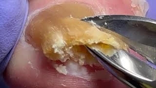 Trim onychomycosis super thick nails very large nails【Doctor Liu Pedicure】 [upl. by Isidoro717]