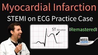 Myocardial Infarction  STEMI on ECG  Practice EKG [upl. by Anez]