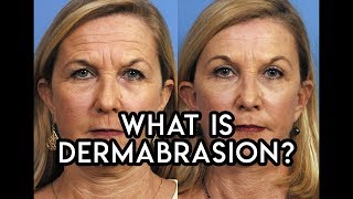 Dermabrasion [upl. by Nappy920]