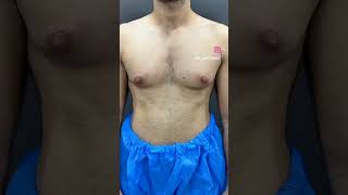 Gynecomastia Surgery Results [upl. by Ainelec]