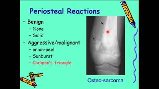 Bone tumors who to characterize a lesion [upl. by Anaidiriv351]