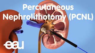 Removal of kidney stones PCNL [upl. by Eralcyram]