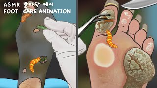 ASMR Satisfying Treatment cracked feet  Remove CallusesCornPlantar Warts  Tingles [upl. by Heddi]