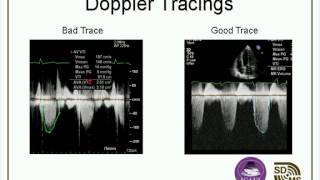 Optimizing Your Echo Images amp Doppler Evaluations webcast [upl. by Lilaj135]