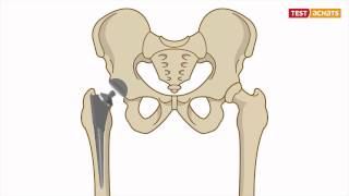 Prothèse de la hanche  lintervention [upl. by Brendon]