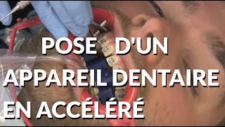 Pose dun appareil en accéléré  Appareildentaireinfo [upl. by Eelirem]