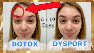 Botox Vs Dysport  Before and After [upl. by Dorion]