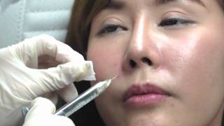 Juvederm Fillers [upl. by Esorbma]