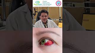 Subconjunctival haemorrhage  आखो मैं लाली  High BP effect on Eyes  Visioncare India [upl. by Cogn]