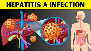 Hepatitis A Infection  Signs amp Symptoms Risk Factors Virology Diagnosis And Treatment [upl. by Atteloc]