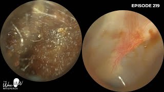 220  Difficult Ear Wax Removal in Narrow Ear with the WAXscope [upl. by Hcirteid]